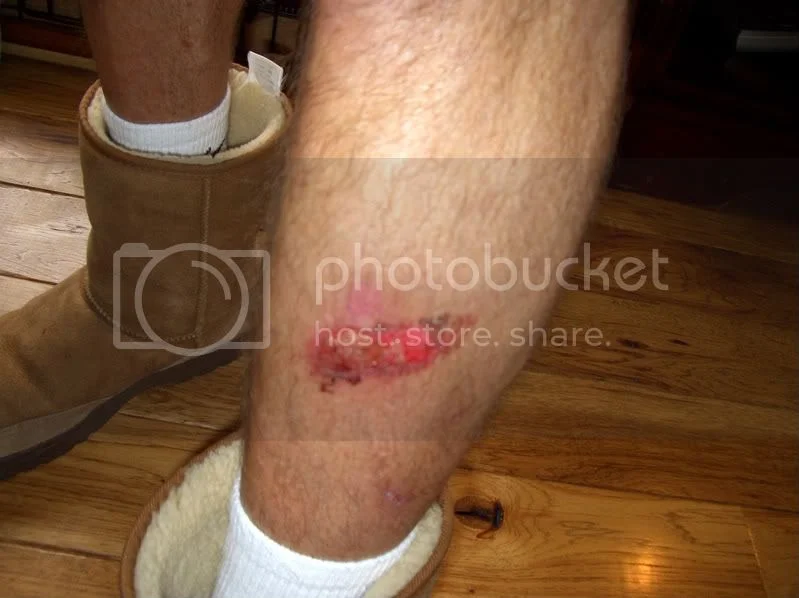 muffler burn pictures Access Norton